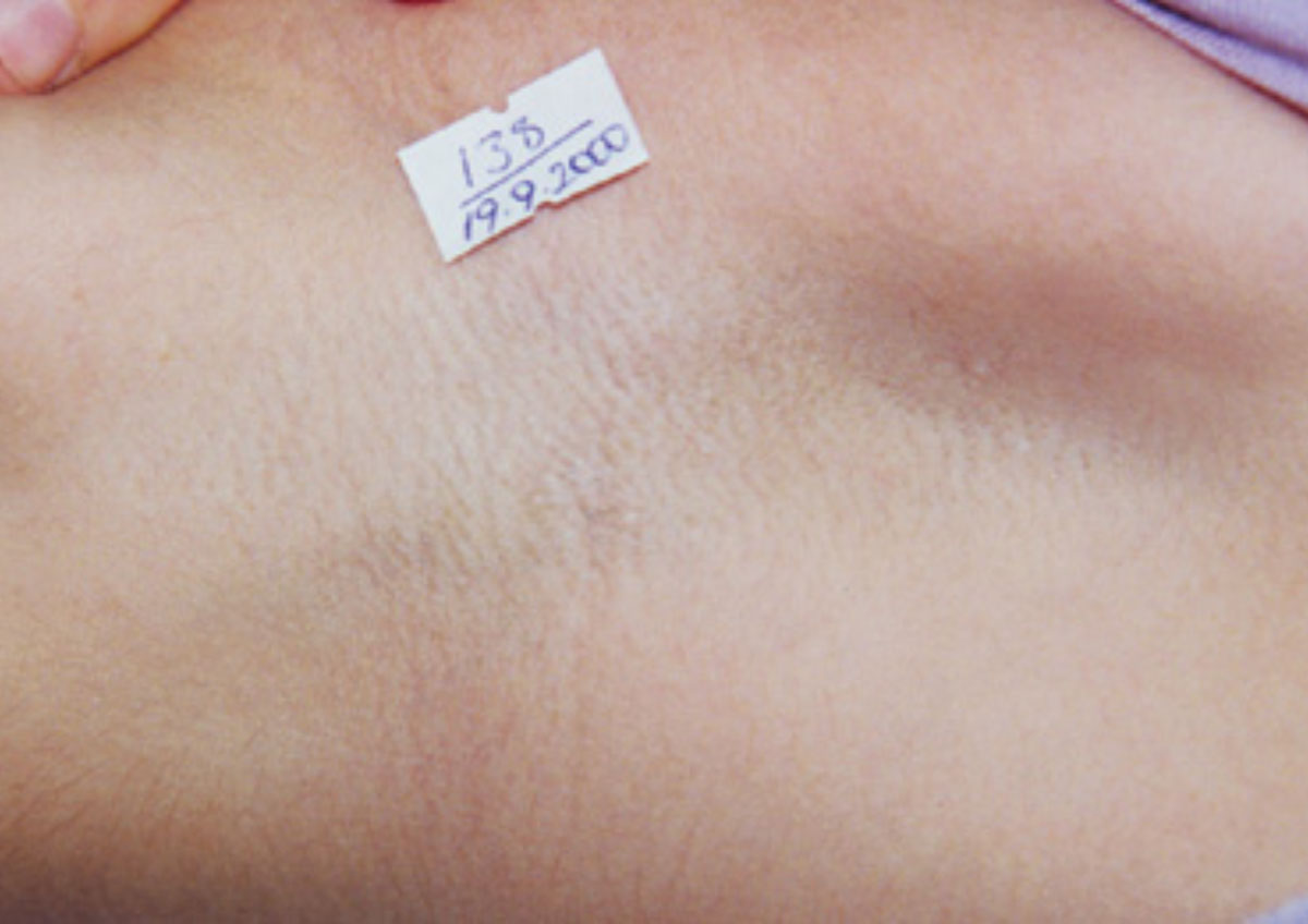 smooth underarm after laser hair removal in Chicago Ridge clinic