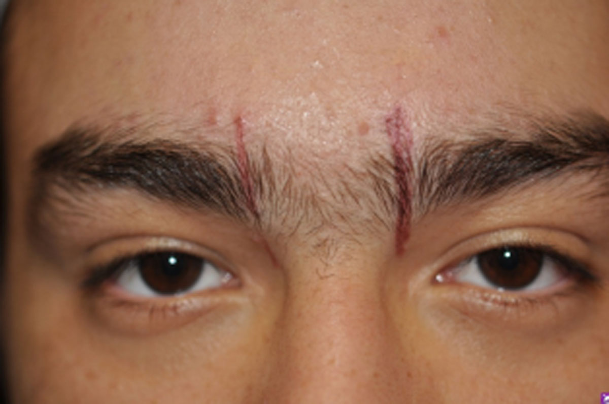 facial scarring around eyebrows before laser treatment in Chicago Ridge