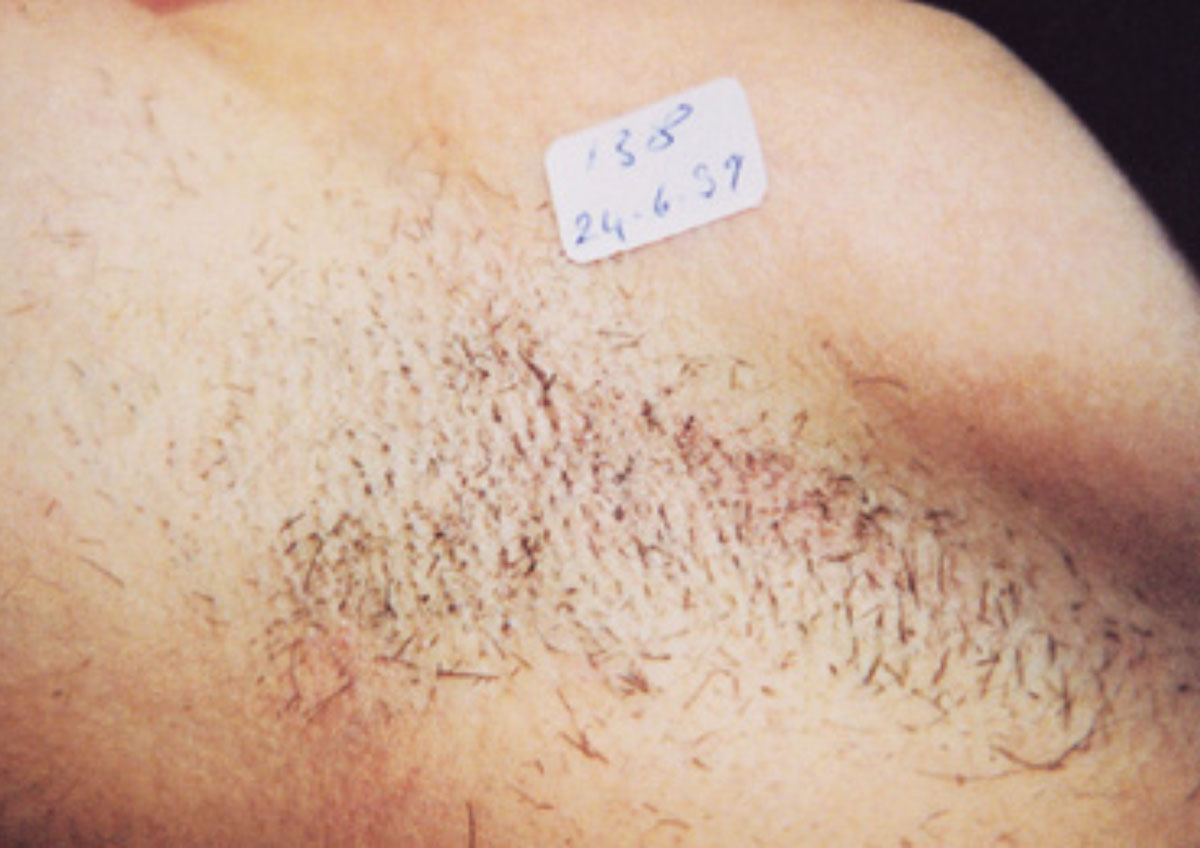 underarm hair before laser hair removal treatment