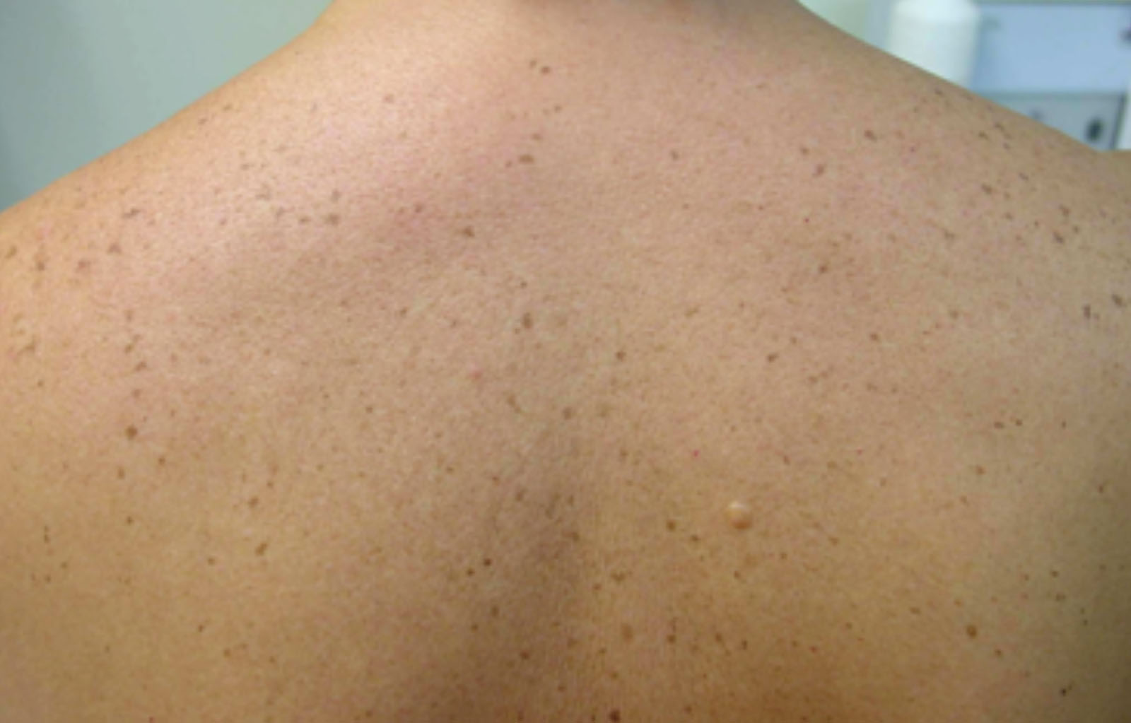 spots on back before GentleMax Pro laser treatment