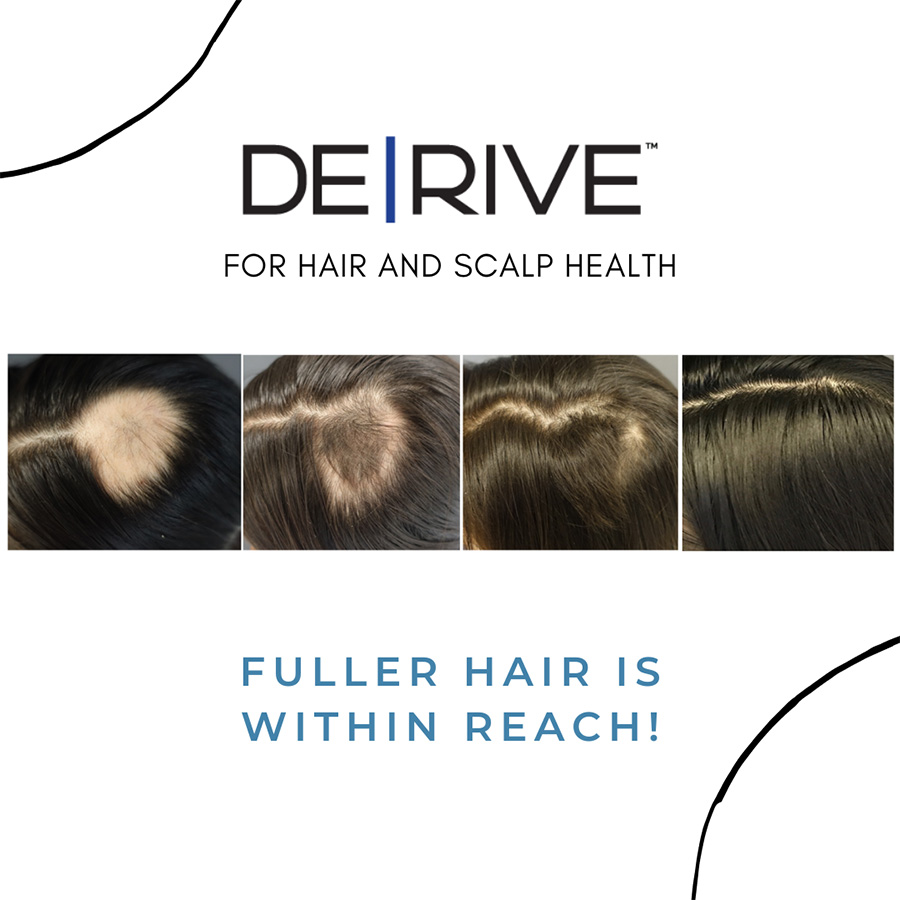 progression of hair growth with Derive in Chicago Ridge clinic