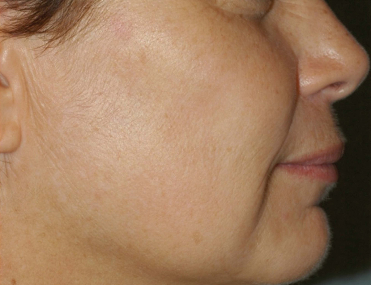After laser skin treatment - mark no longer visible