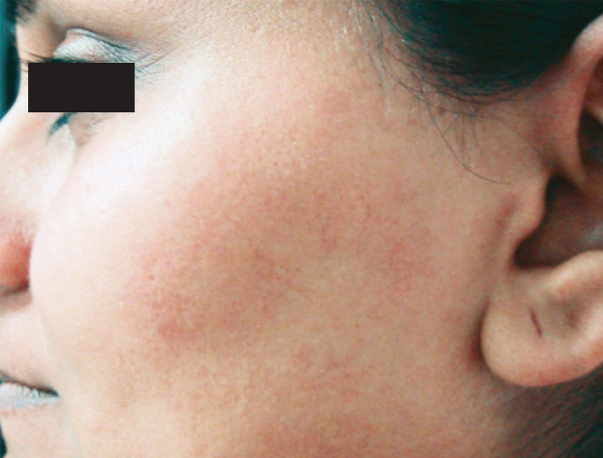 All hair on side of face removed with laser hair removal