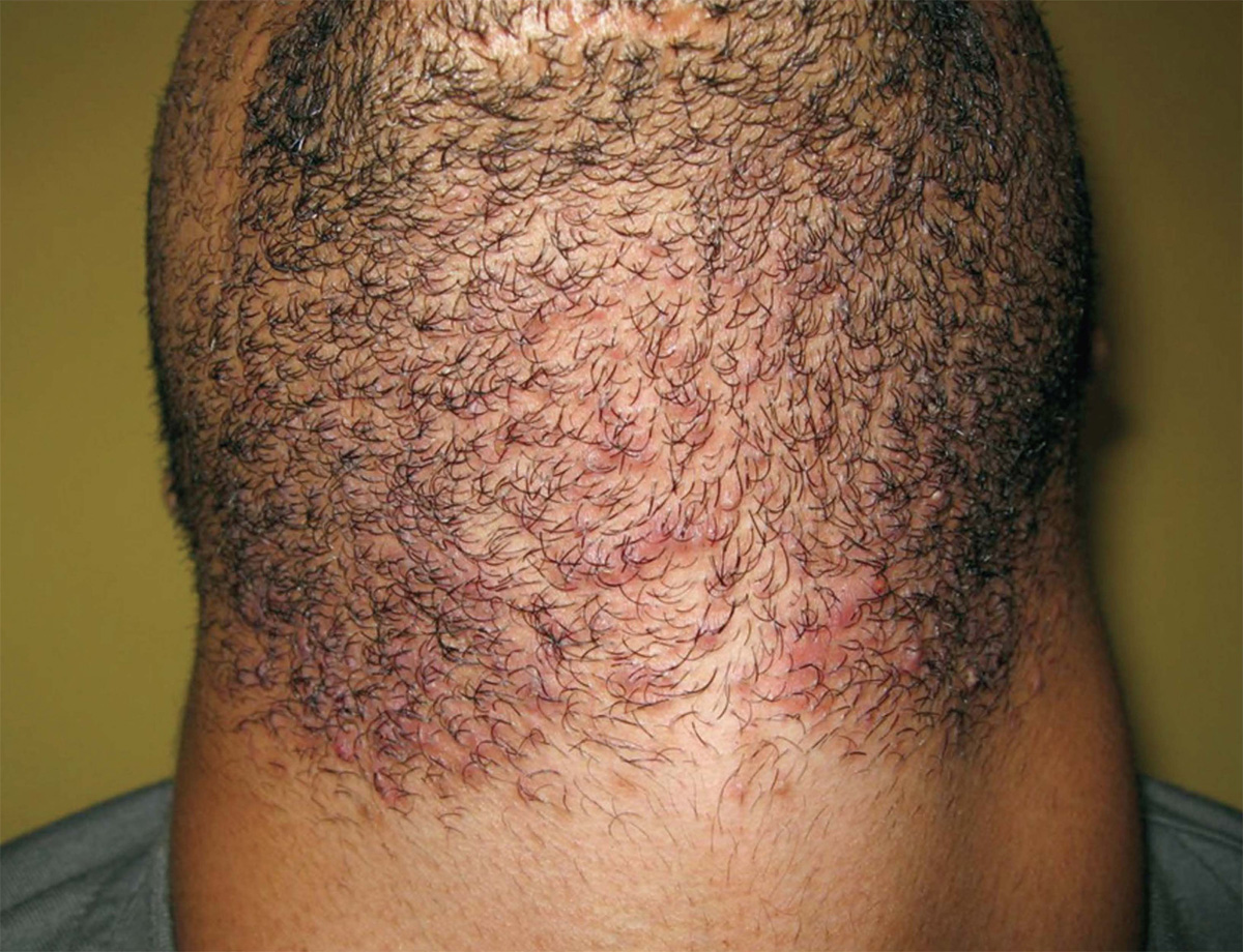 Photo of man's chin and neck hair with bumps and ingrown hairs: Before GentleMax laser hair removal