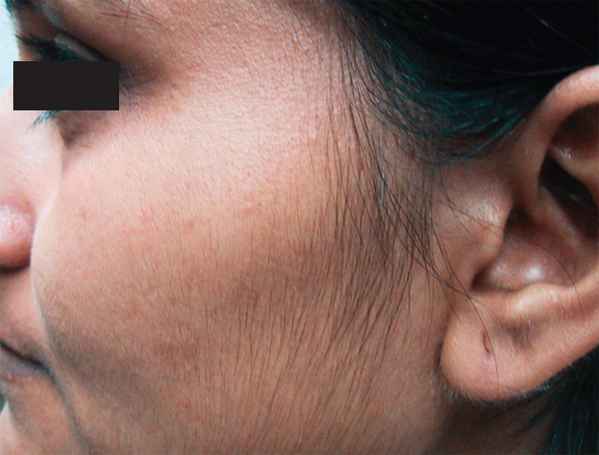 View of side of woman's face with hair covering cheek - before laser treatment