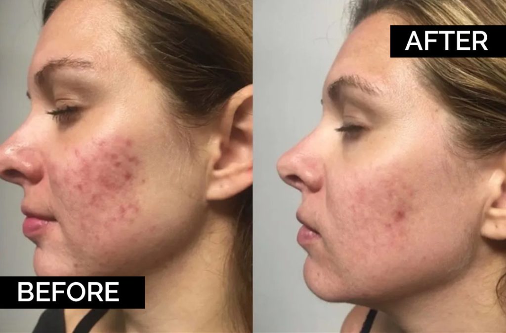 VI Chemical Peels, Skin Care & Dermatology in Chicago at Star Care Family Wellness